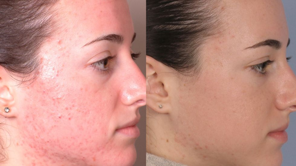 Before &After